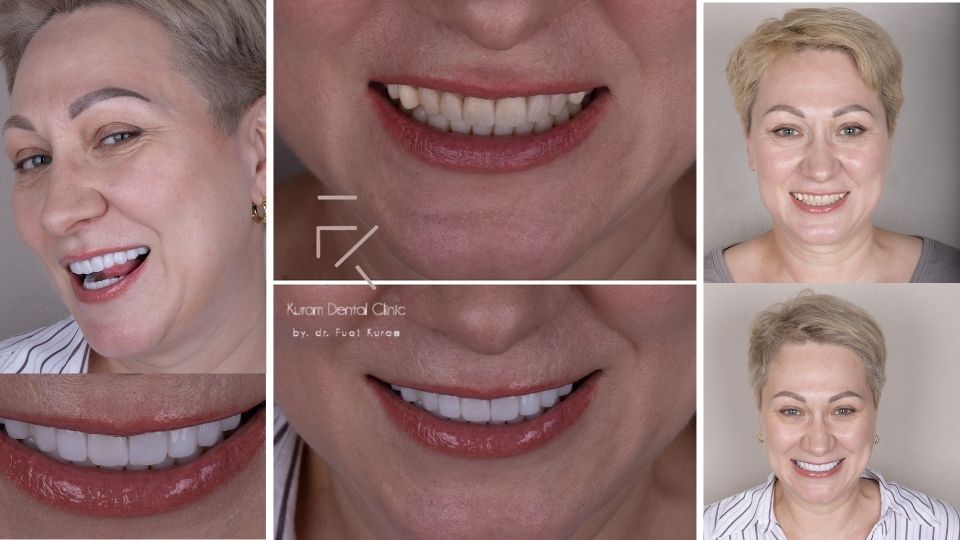 Hollywood Smile Antalya Hollywood Smile Antalya at Kuram Dental Clinic
