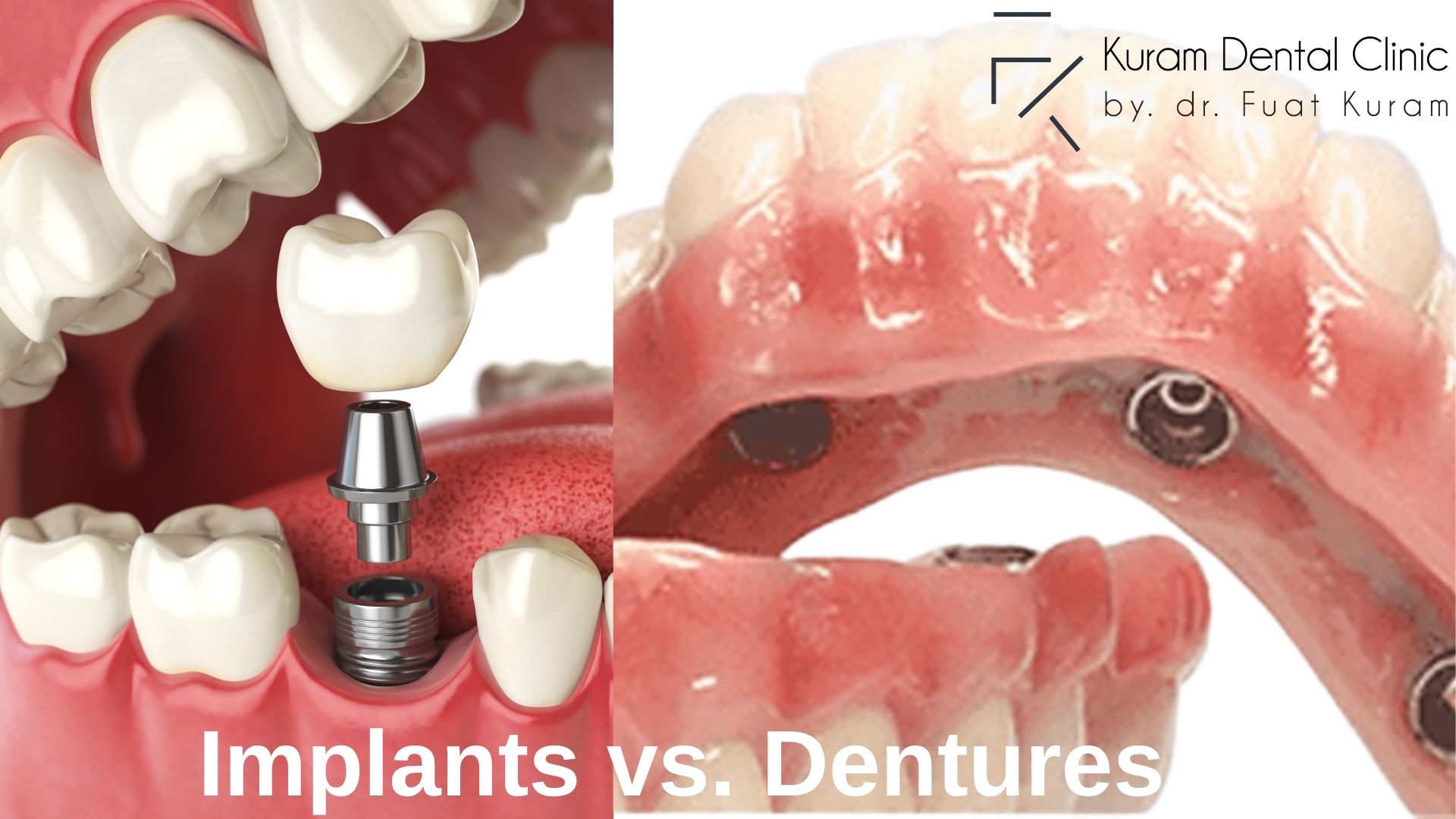 Dental implants vs Dentures