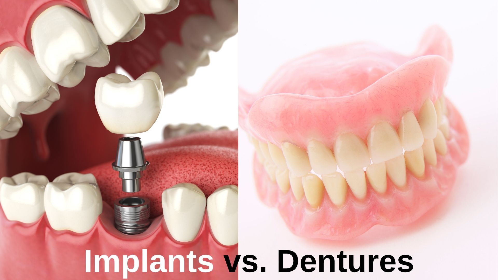 implants-vs-dentures-turkey