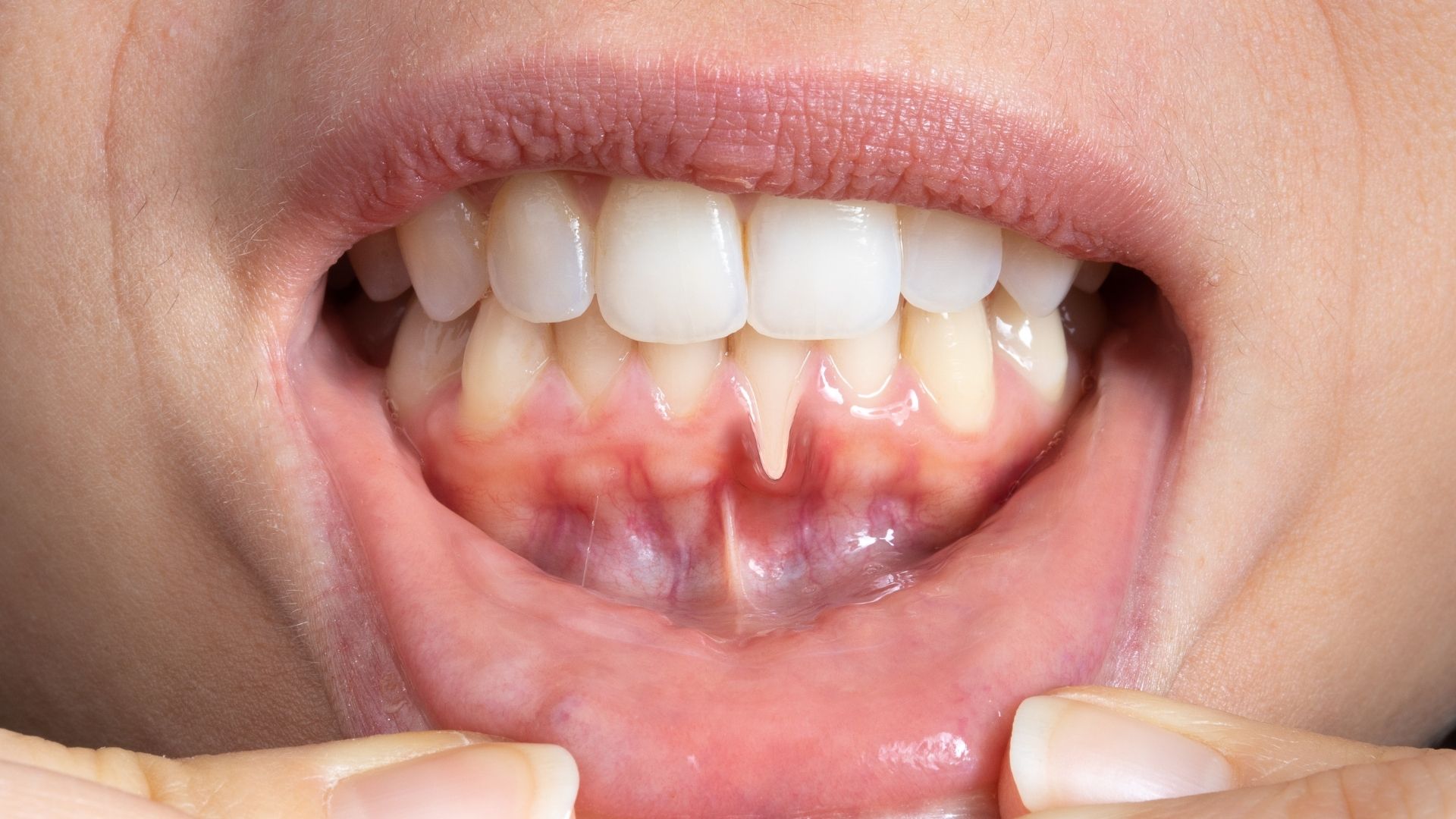 Receding Gums Receding Gums-1