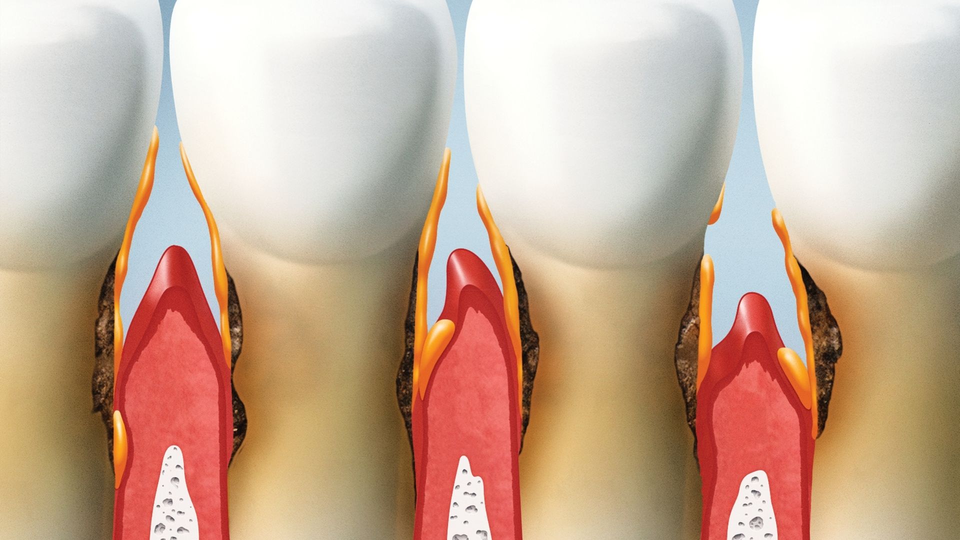 What do receding gums look like? What do receding gums look like?