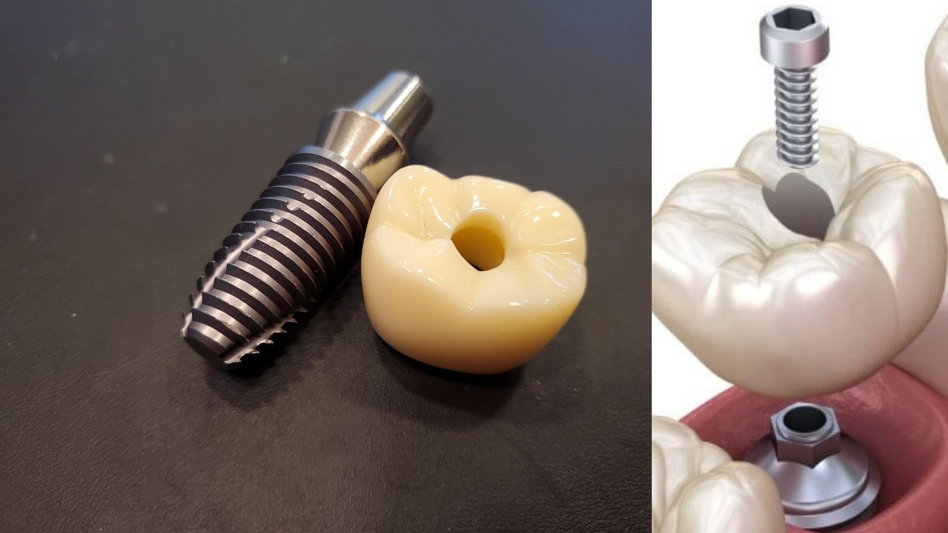 What are screw implants? What are screw implants?