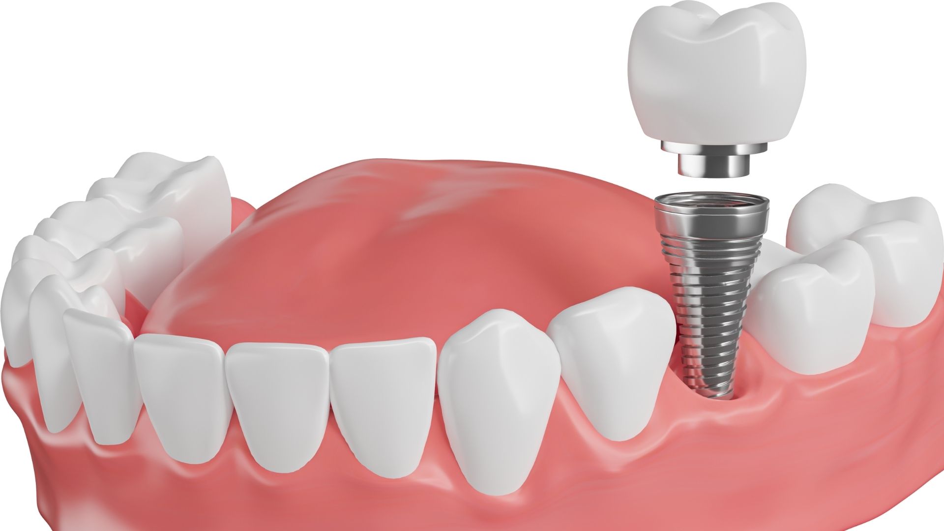 What are screwless dental implants/bonding implants? What are screwless dental implants/bonding implants?