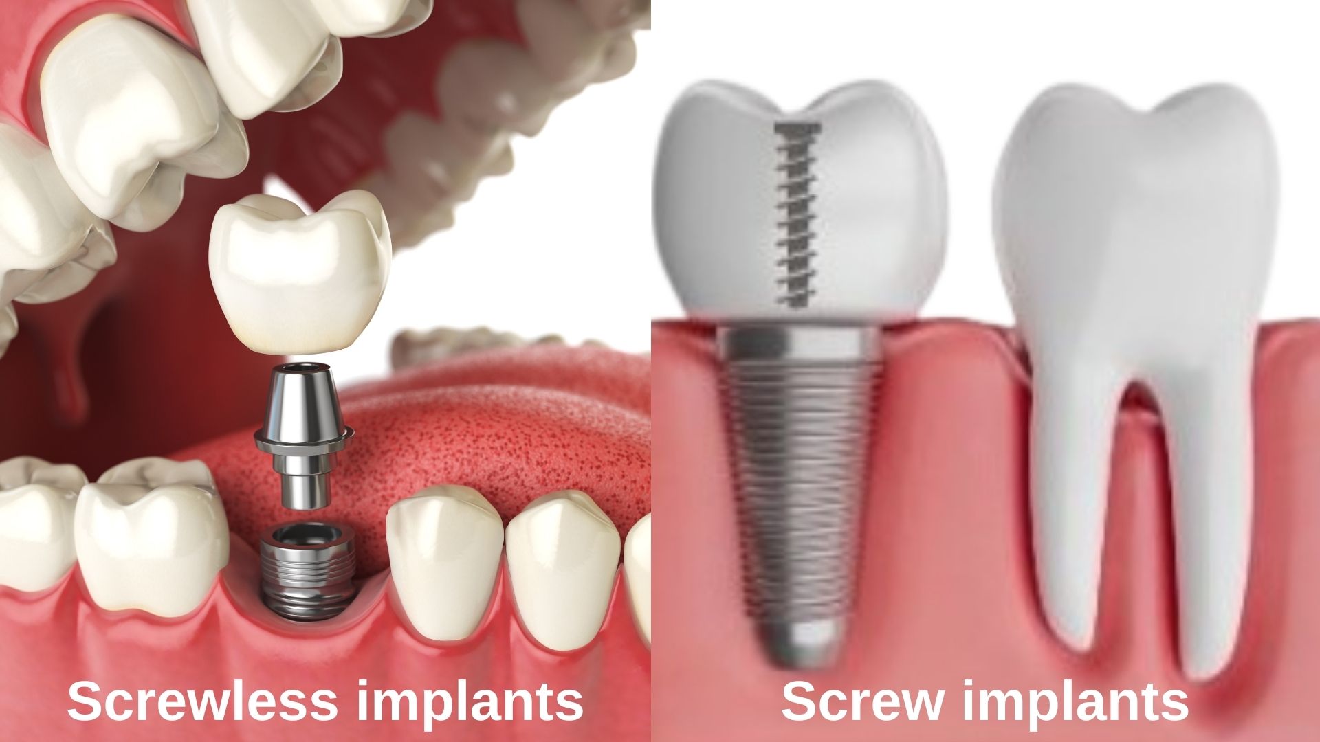 What are screwless implants? Screw Implant or Bonding Implants?