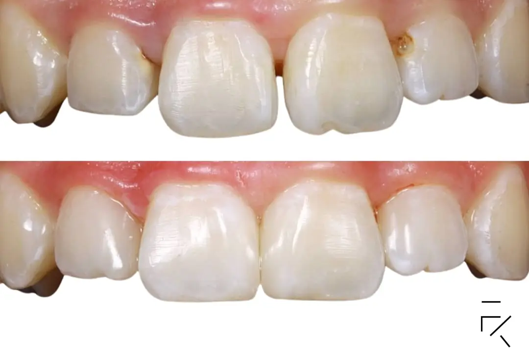 Gappy teeth treatment with veneers Gappy teeth treatment with veneers