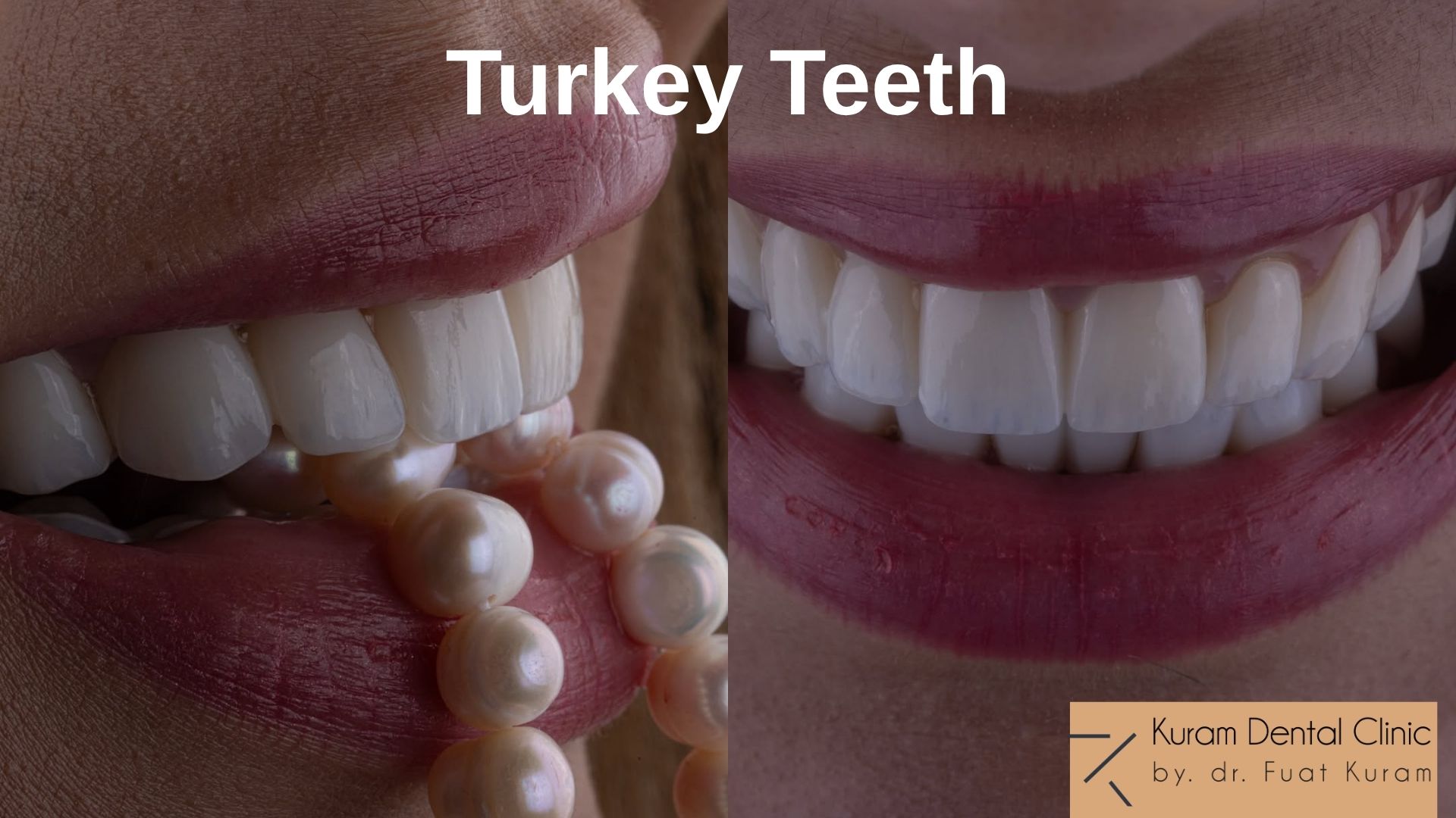 turkey-teeth