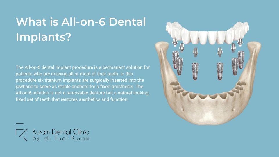 All-on-6 implants What is All-on-6 in Turkey?